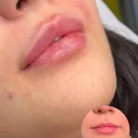 تزریق ژل و بوتاکس درکلینیک تخصصی زیبایی سانی
