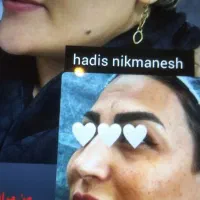 درمان لک و کک و مک ۹۹۰ فقط تا عید قربان