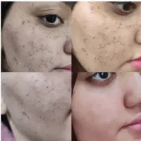 جوانسازی صورت
