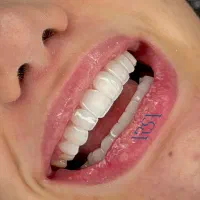 دندانپزشکی زیبایی لمینت کامپوزیت طبیعی قیمت مناسب