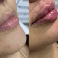 تخفیفات عیدتا عید انواع جراحی زیبایی توسط فوق تخصص