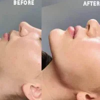 تزریق ژل و بوتاکس تخصصی با ۳۰٪ تخفیف