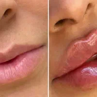 تزریقات ژل و بوتاکس