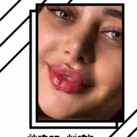 تخفیف ویژه خدمات ژل و بوتاکس