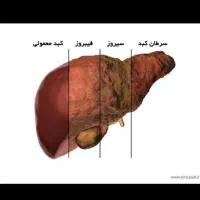 درمان کبد چرب