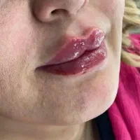 تخفیف ویژه ژل و بوتاکس ،پک ۱۰cc فول فیس