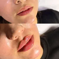 تزریق ژل چانه گونه لب زیر چشم در کلینیک زیبایی