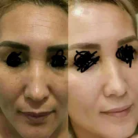 بمب ضد لک و ضد جوش