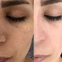 درمان لک بصورت تضمینی پوستت سفید کن