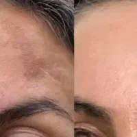 با یه دوره تضمینی لک هاتو از بین ببر