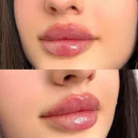 آموزش فیلر بوتاکس مزوتراپی مزوژل آنزیم فیلر بادی