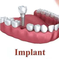 کاشت دندان. ایمپلنت یکروزه تضمینی