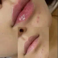 تزریق ژل و بوتاکس