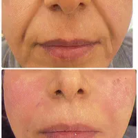 ژل بوتاکس فیلر مزوتراپی پیرسینگ و آموزش حرفه ایی