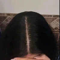 تا کچل نشدی با این محلول موهاتو کلی پرپشت کن
