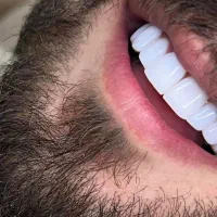 دندانسازی با تخفیف ویژه