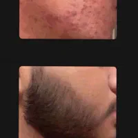 سرم ریش ساز معجزه برای آقایون