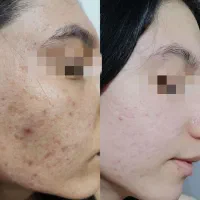پاکسازی صورت درمنزل با کیفیت بالا و قیمت مناسب