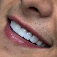 کامپوزیت اقساط بدون پیش پرداخت
