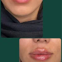 فیلر و ژل لب ، صورت و بدن ، دکتر اسدی صفا