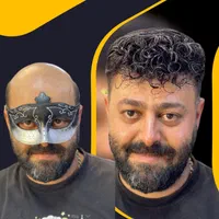 پروتزمو/ترمیم مو  پروتز مو اصفهان