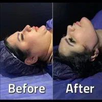 ساکشن غبغب کانتورینگ زاویه فک با دستگاه پال دیجیتا