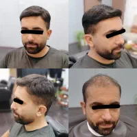 پروتز مو طبیعی کاشت مو بدون درد و نقاهت