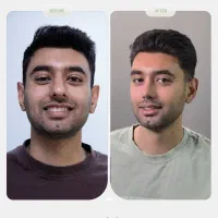 عمل بینی در شیراز فقط با پرداخت 30 میلیون تومن