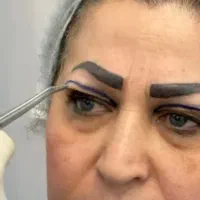 جراحی بلفارو پلاستی .لاب ی اپلاستی.دایرکت ابرو، و