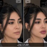 تزریق ژل(فیلر)بادی آنزیم بوتاکس مادلینگ لیفت مزو