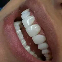 طراحی خط لبخند کامپوزیت