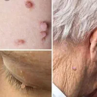 رفع ریشه ای زگیل تناسلی HPV