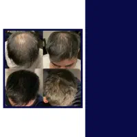 خط رویش درحال عقب رفتنه مشاوره تخصصی