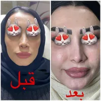 لیزر مو‌- ژل - زیبایی چهره و بدن توسط پزشکان مجرب|خدمات آرایشگری و زیبایی|اردبیل, |دیوار