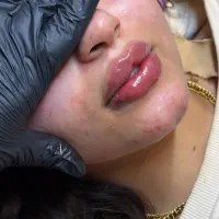 تزریق لب روسی و مادلینگ صورت