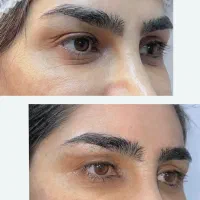 بلفاروپلاستی چشم گربه ای ارومیه