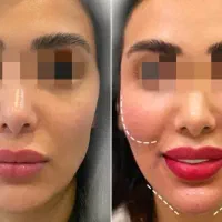 مدل برای تزریق فیلر و چربی و فیلر بادی