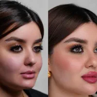 ژل و بوتاکس فقط ۵۰۰ تومان توسط پزشک