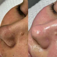 تخفیف آموزش فشیال پاکسازی صورت بامدرک ۳ میلیون۸۰۰