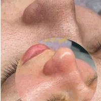 آموزش فشیال پوست