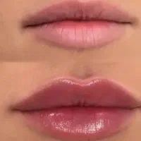 ژل و بوتاکس