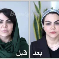 عملMACS LiFT/لیفت صورت/بلفارو/جوانسازی/عمل بینی