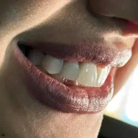 اصلاح لبخند بدون آسیب مشاوره رایگان