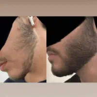 رویش ریش سبیل