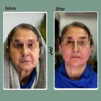 بوتاکس لیزر فیشال‌‌ لیفت نخ مزو prp مو توسط پزشک