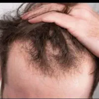 تونیک ضد ریزش مو