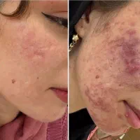 کرم ۸ کاره اصل رفع لک چروک و جای جوش ملاسما