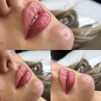 جشنواره فیلر و مزوژل جوانساز (پزشک متخصص)