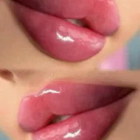 تزریق ژل ، بوتاکس و مزوتراپی