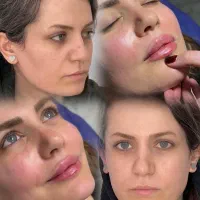 تزریق ژل ،فیلر بوتاکس توسط پزشک با تجربه در کلینیک